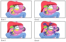 4 Evre Pankreas Kanseri Belirtileri ve Tedavisi