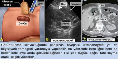 Pankreas Kanseri Kemoterapi