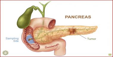 Pankreas Kanseri Yaşam Süresi