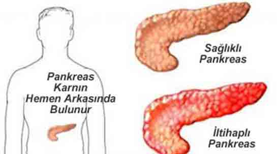 Pankreas Enfeksiyonu